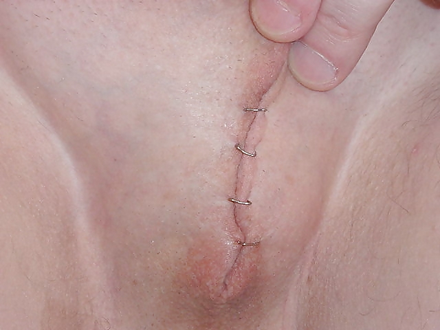 Temp Nullo - Sutures and Staples #6066281