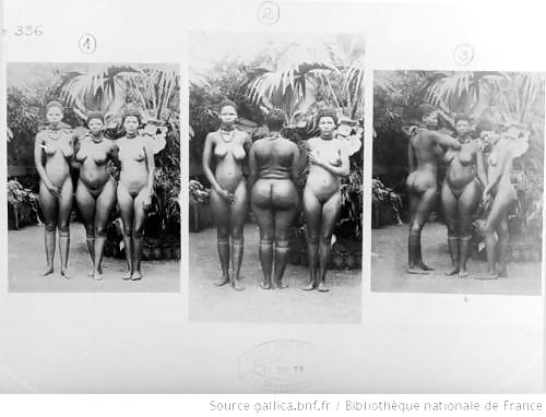 STEATOPYHGIA #21889667