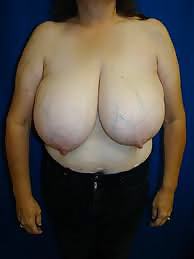 Breast hypertrophy - beautiful! #21857990