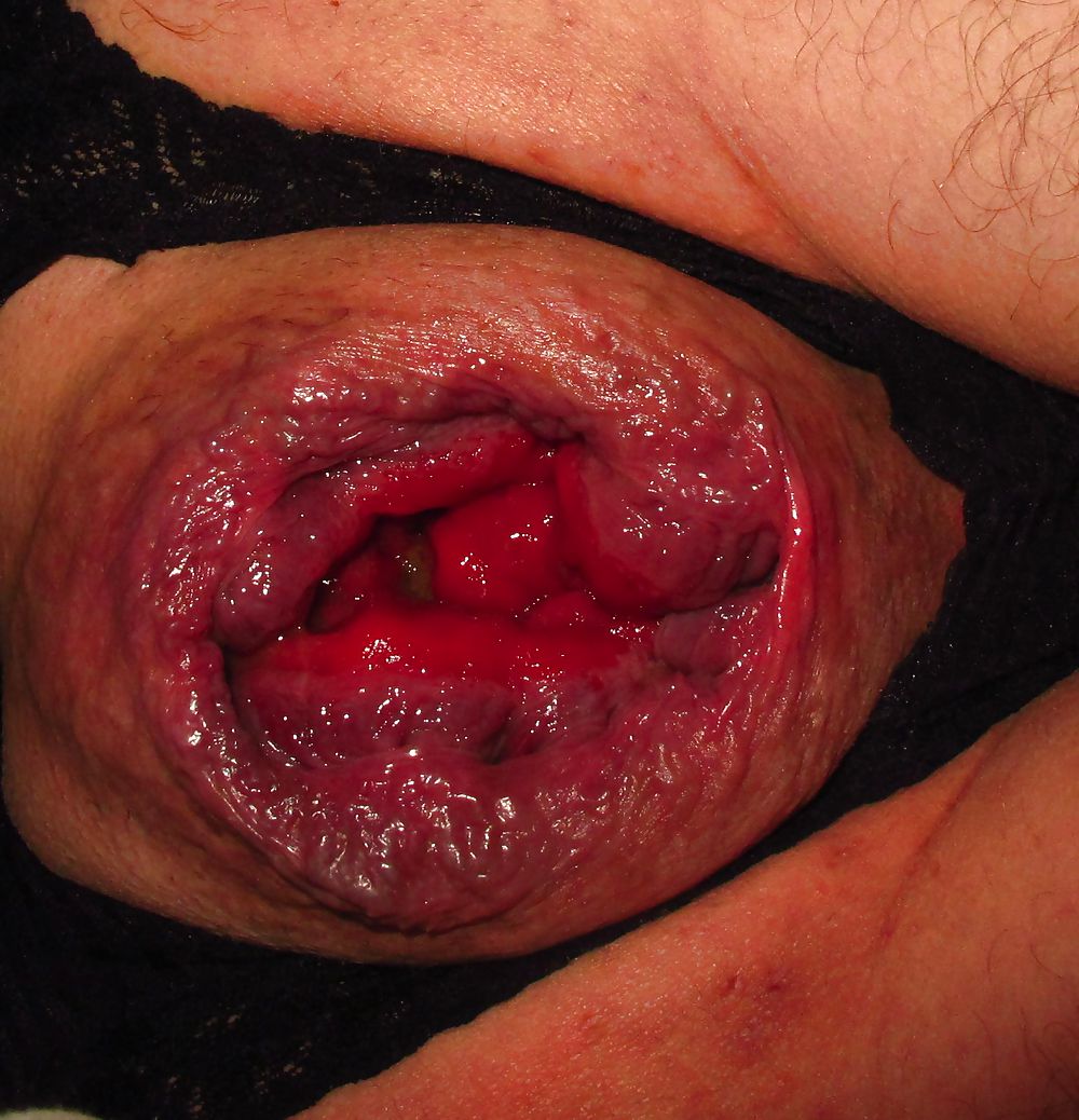 Coarse prolapse peep asshole by Marques #9965793