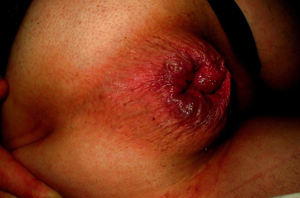 Extreme prolapse gape asshole by Marques #9965858