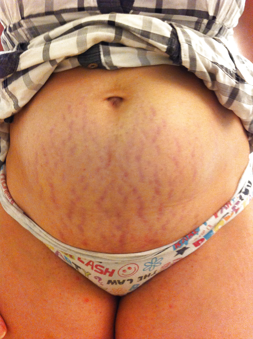 Vergeture - grossesse
 #22266318