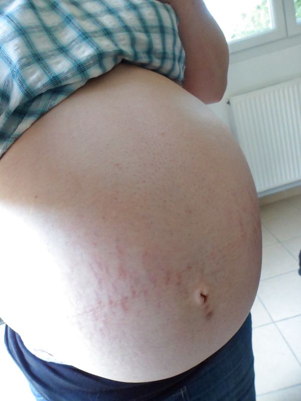 Vergeture - grossesse
 #22266324