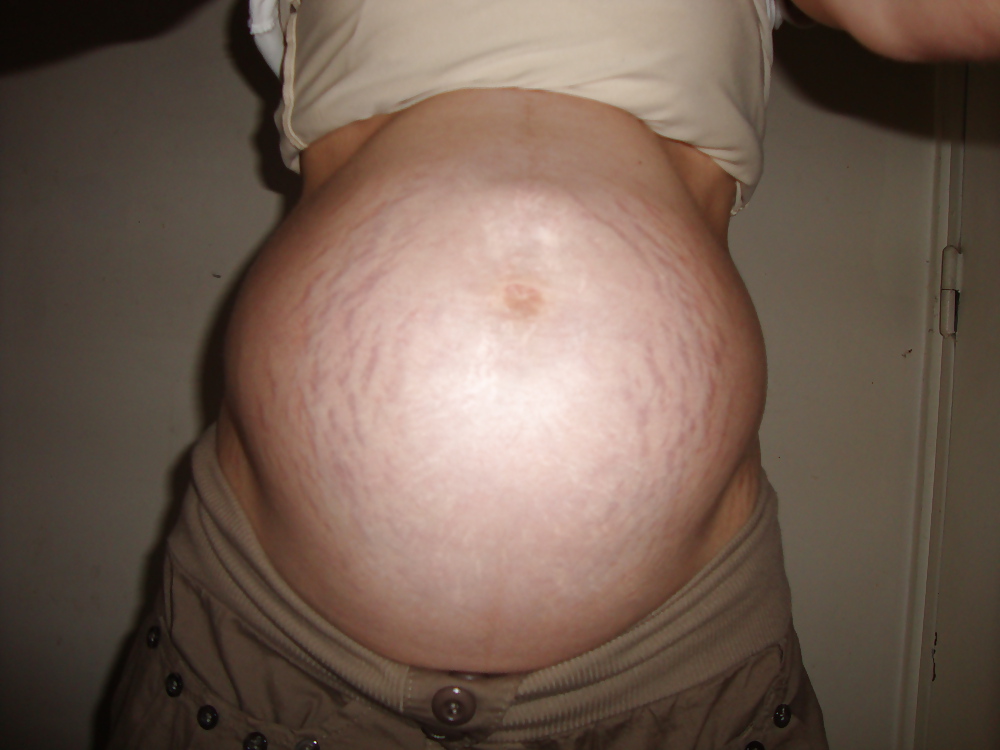 Vergeture - grossesse
 #22266328