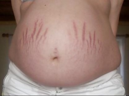 Vergeture - grossesse
 #22266329