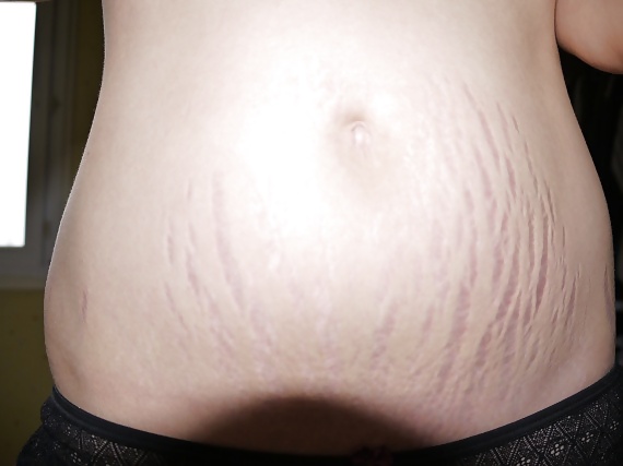 Vergeture - grossesse
 #22266335