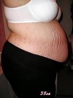 Vergeture - grossesse #22266340