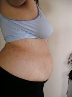 Vergeture - grossesse
 #22266343