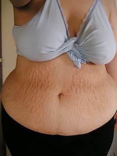 Vergeture - grossesse
 #22266346