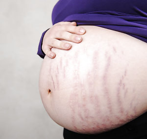 Vergeture - grossesse
 #22266349