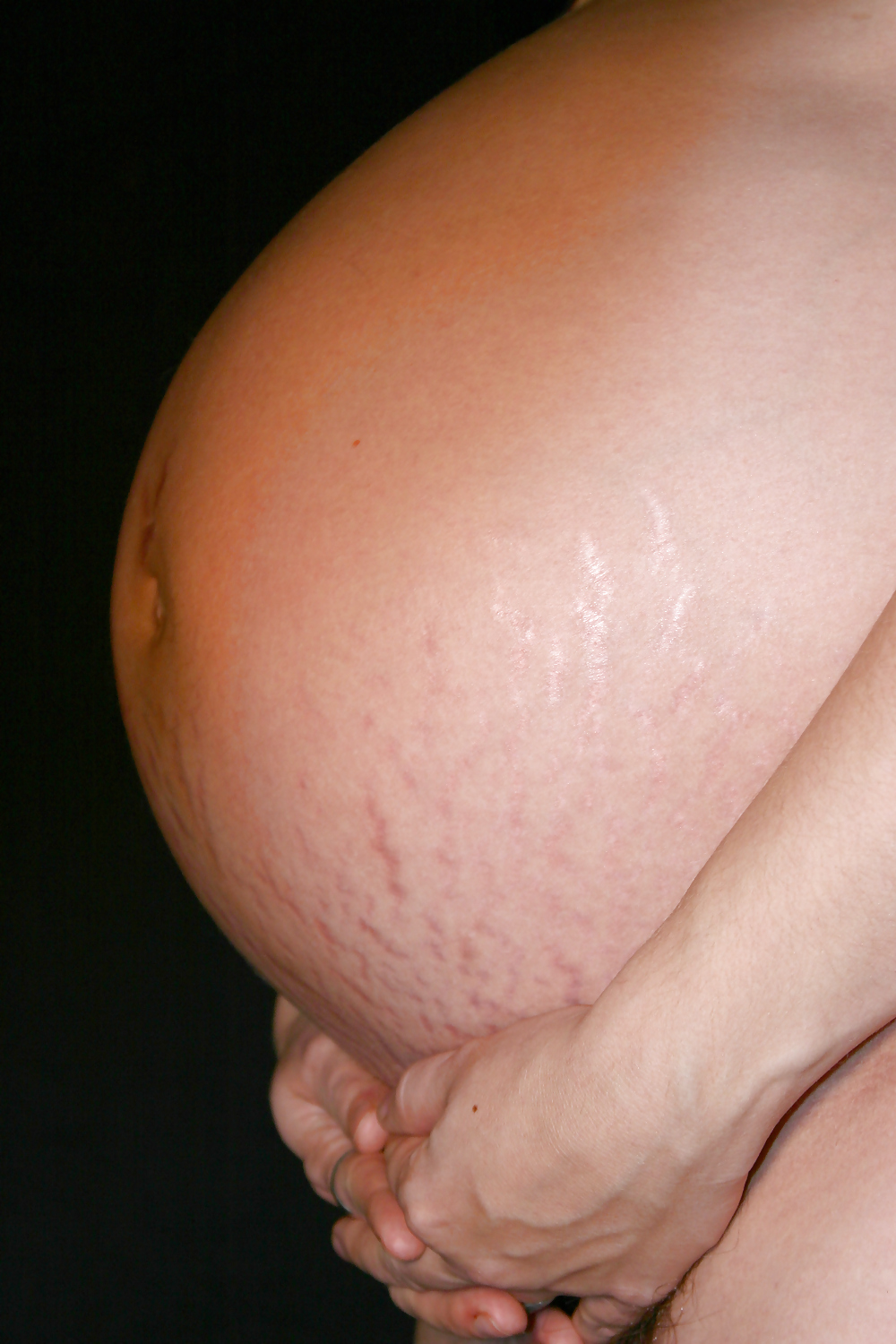 Vergeture - grossesse
 #22266356