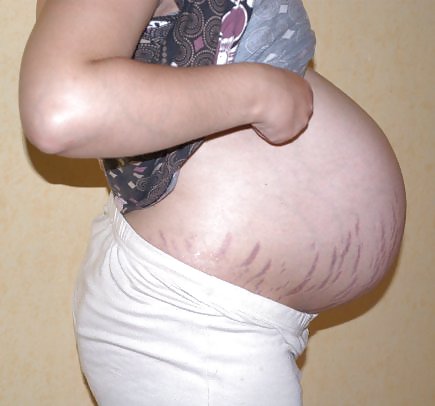 Vergeture - grossesse
 #22266359