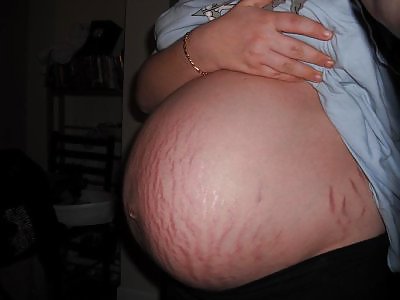 Vergeture - grossesse
 #22266364