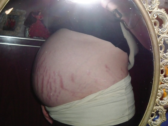 Vergeture - grossesse
 #22266367