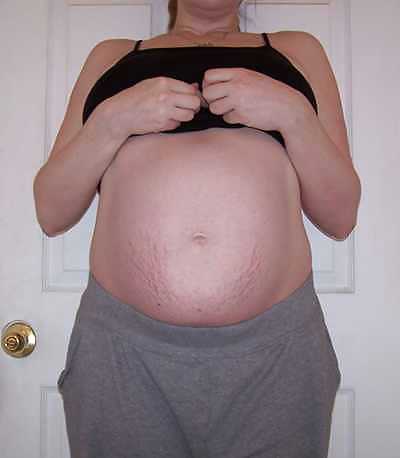 Vergeture - grossesse
 #22266378