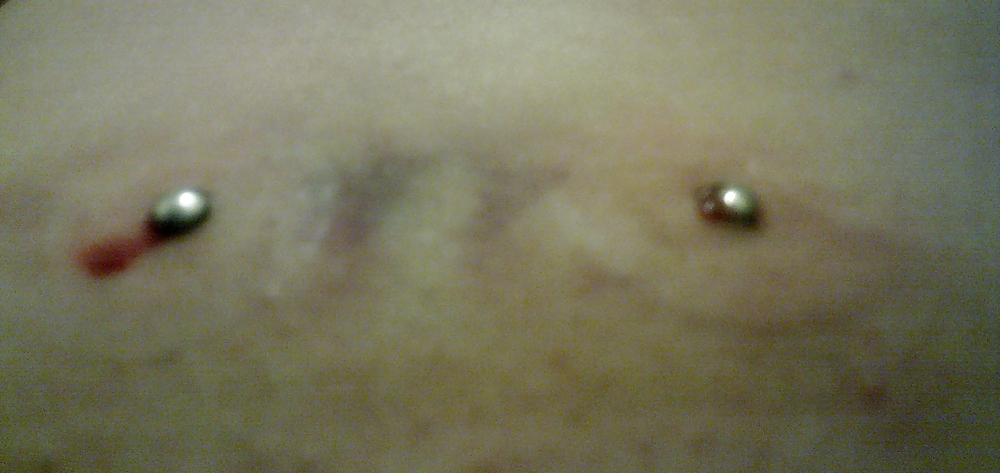 Micro dermales
 #3036560