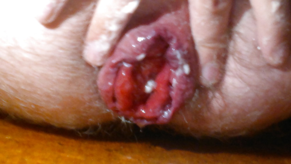 Prolapse #13112839
