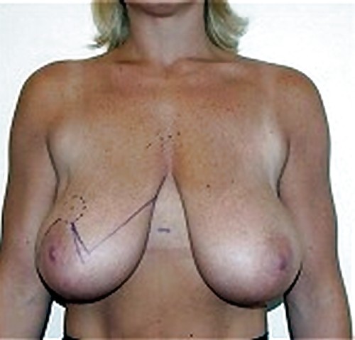 大きな天然の垂れ乳の手術前の写真
 #1650895