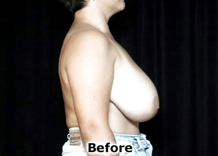 Big Natural And Saggy Tits Pre-OP Pictures #1650936