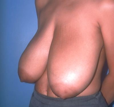 大きな天然の垂れ乳の手術前の写真
 #1650975
