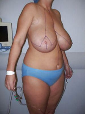 大きな天然の垂れ乳の手術前の写真
 #1651041