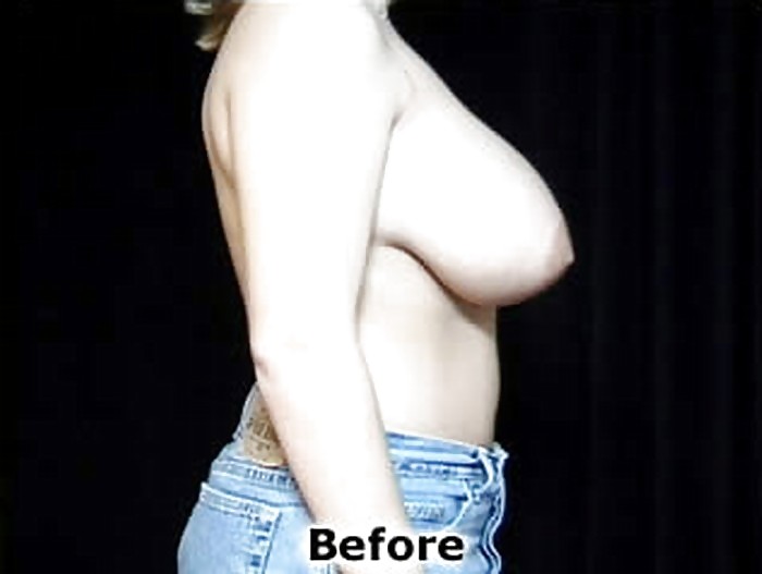 Big Natural And Saggy Tits Pre-OP Pictures #1651073
