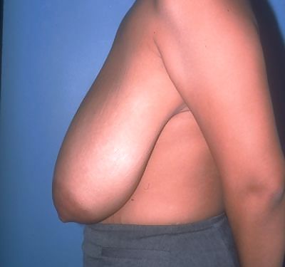大きな天然の垂れ乳の手術前の写真
 #1651105