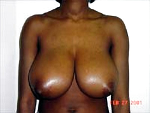 Big Natural And Saggy Tits Pre-OP Pictures #1651118