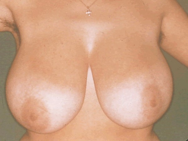 大きな天然の垂れ乳の手術前の写真
 #1651140