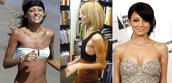 Silicone-implants #4042166