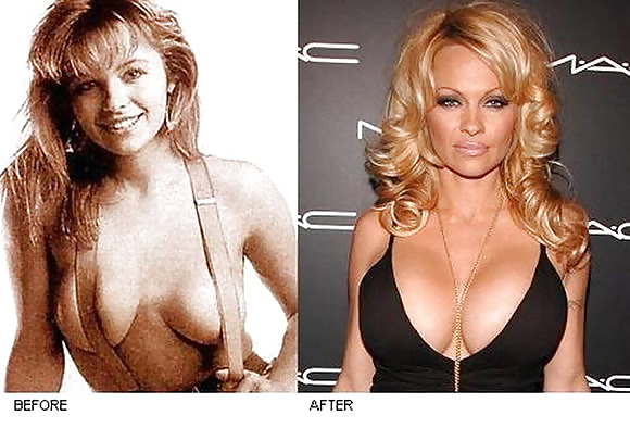 Silicone-implants #4042172