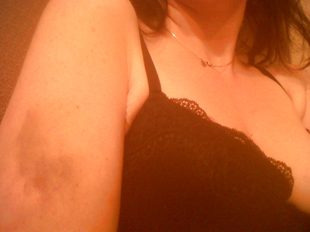 Bruises from my trip to Daddy #7930130