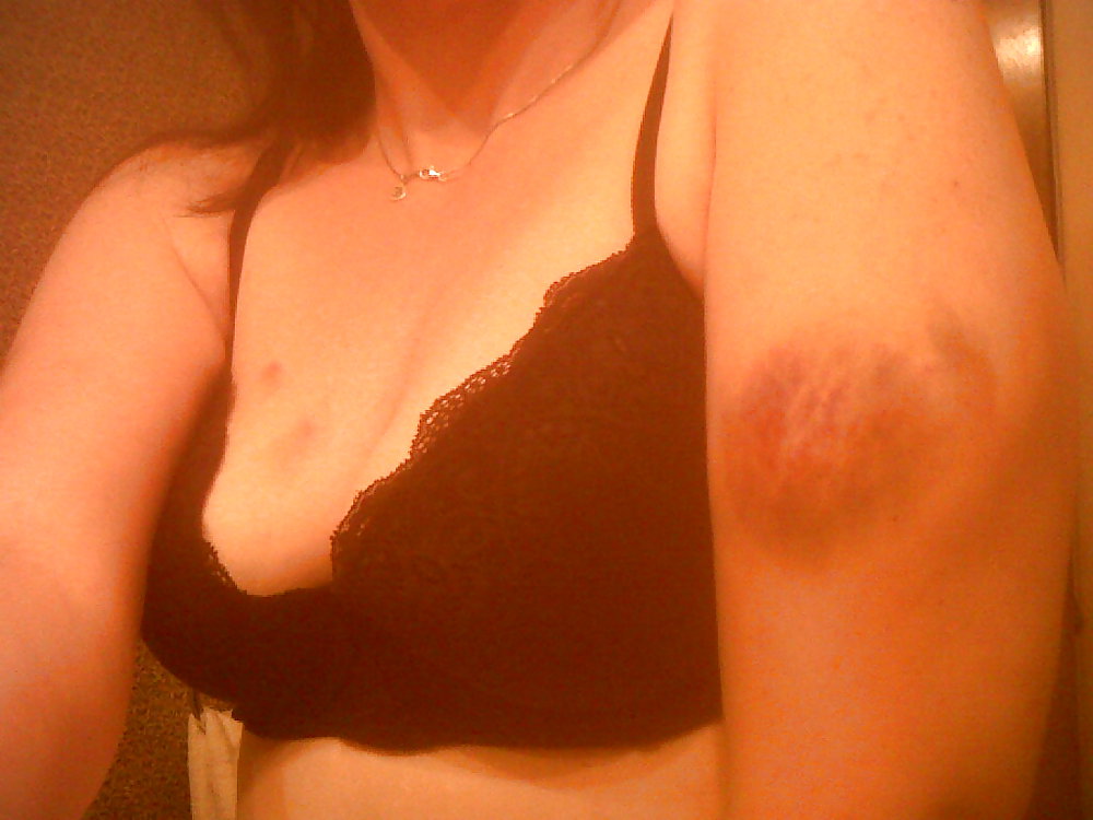 Bruises from my trip to Daddy #7930138