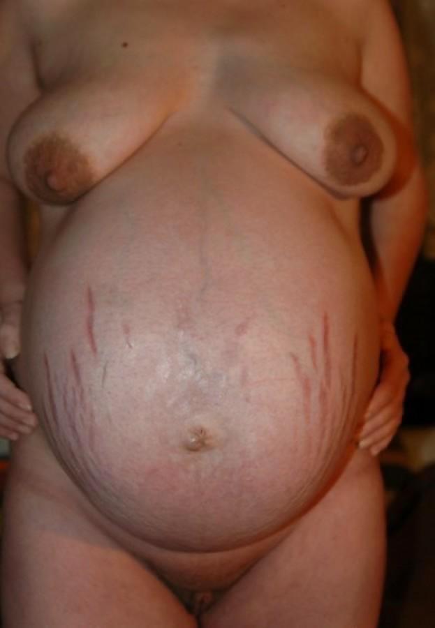 Pregnant Stretchmarks #19559462
