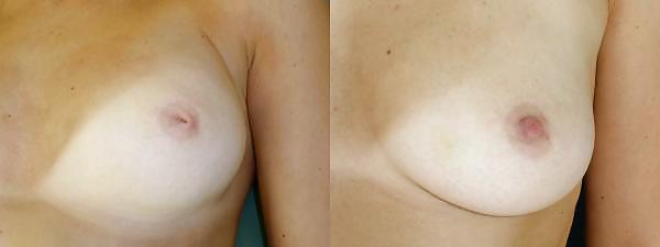 Series of girls and females with inverted nipples #3 #10032834