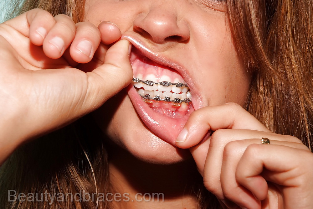 Luminous teen with Braces #9817415