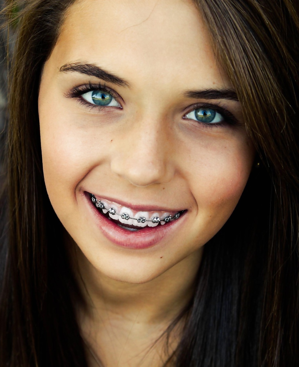 Teens With Braces 4 #29907628