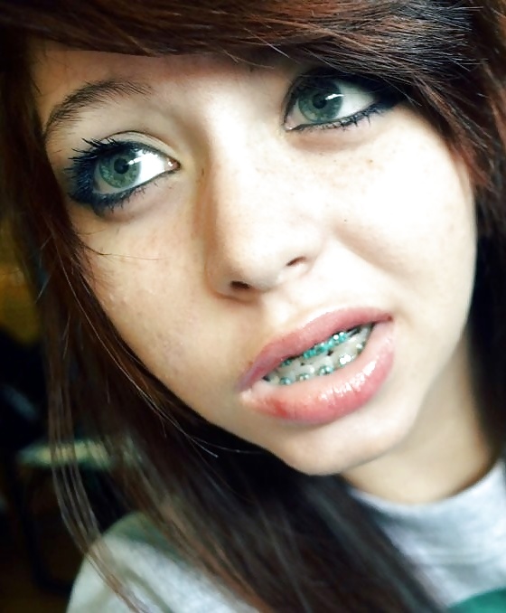 Teens With Braces 4 #29907656