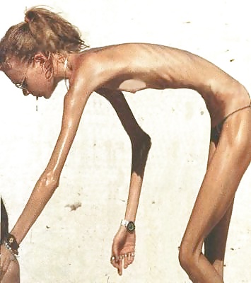 Anorexic Girls #31652598