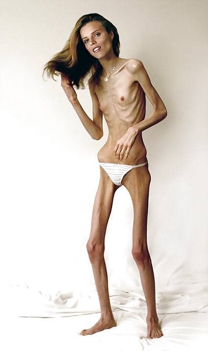 Anorexic Girls #31652614