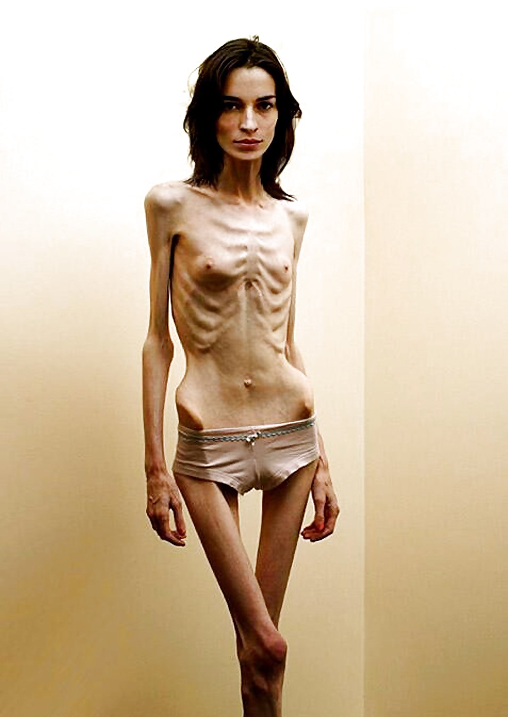 Anorexic Girls #31652615