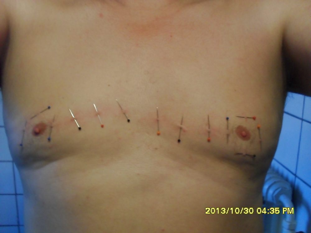 Tit treatmeant #40373493