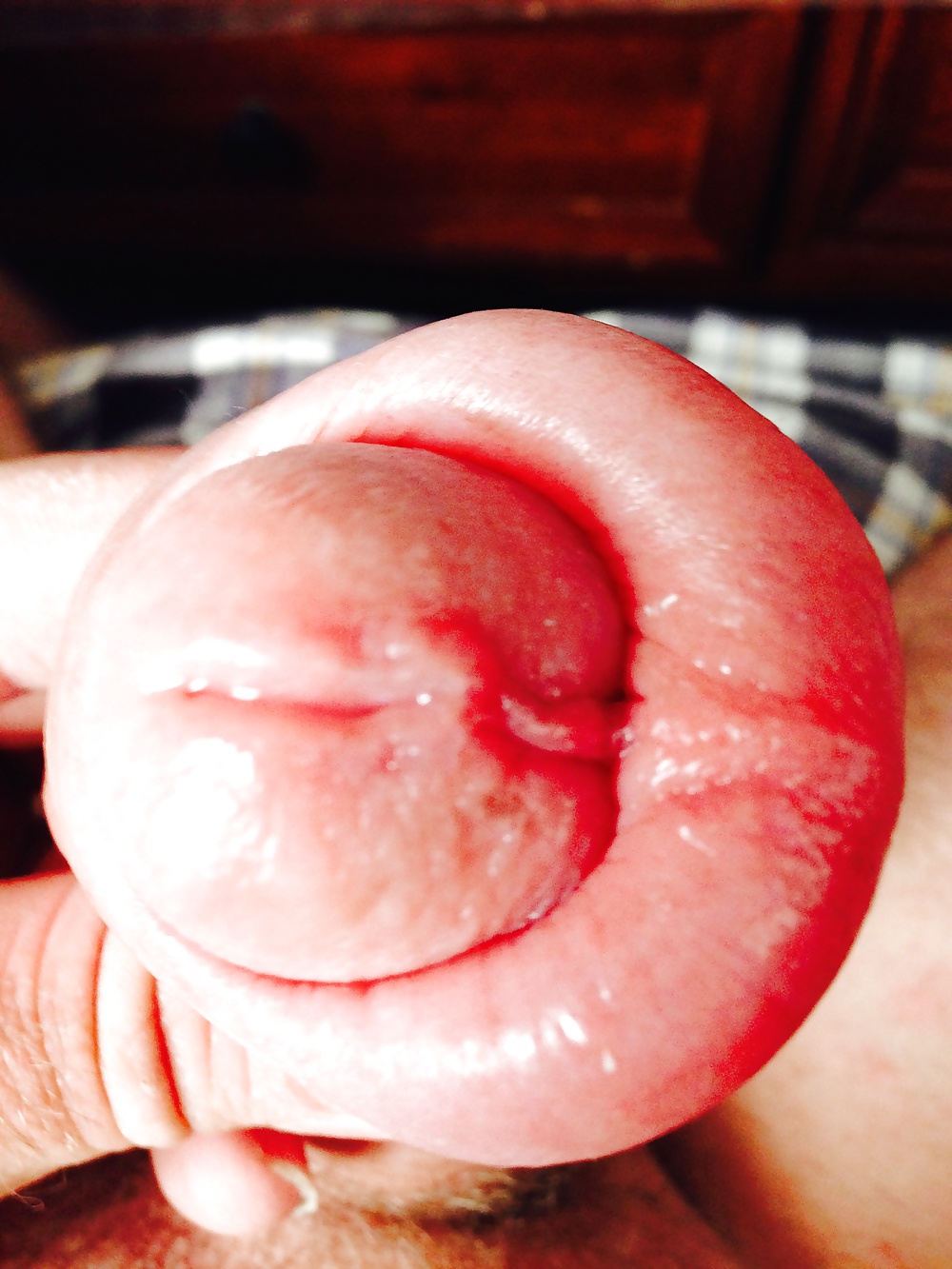 Huge swollen foreskin brutal pump severe bruising  #29913895