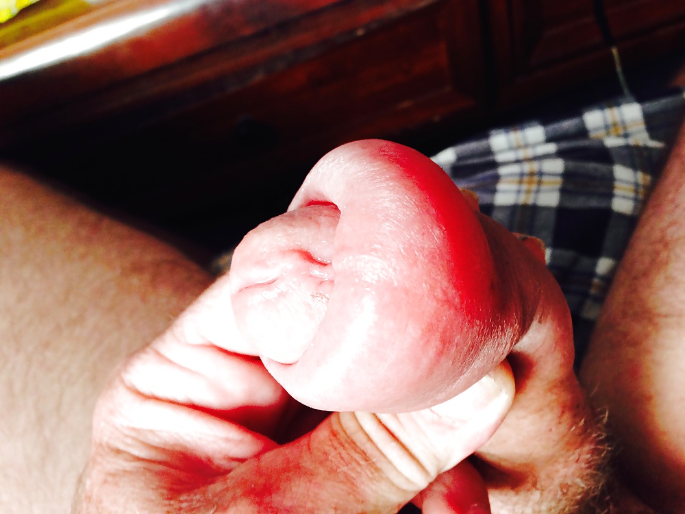 Huge swollen foreskin brutal pump severe bruising  #29913897