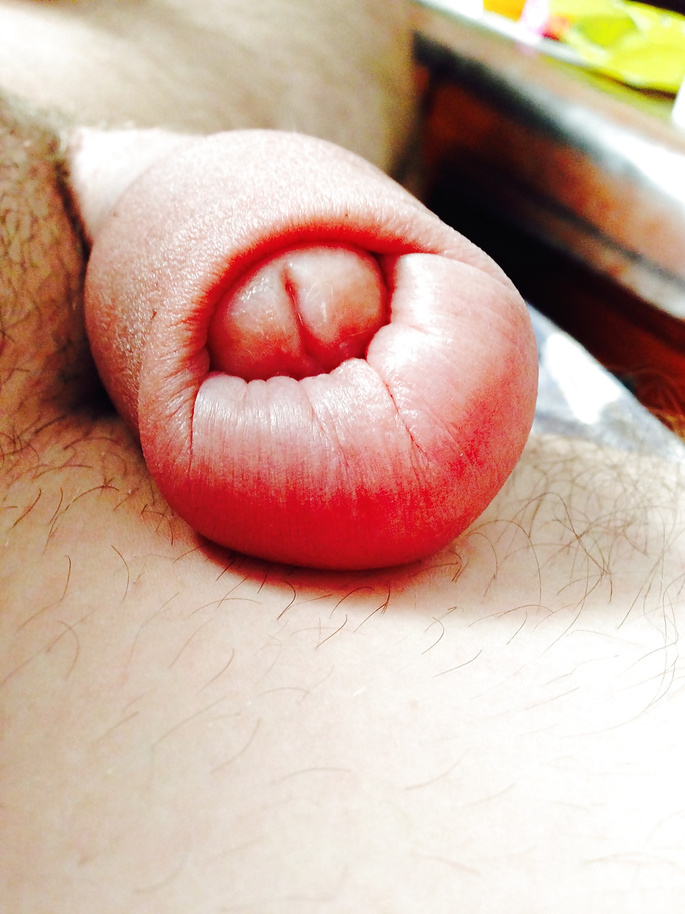 Huge swollen foreskin brutal pump severe bruising  #29913925