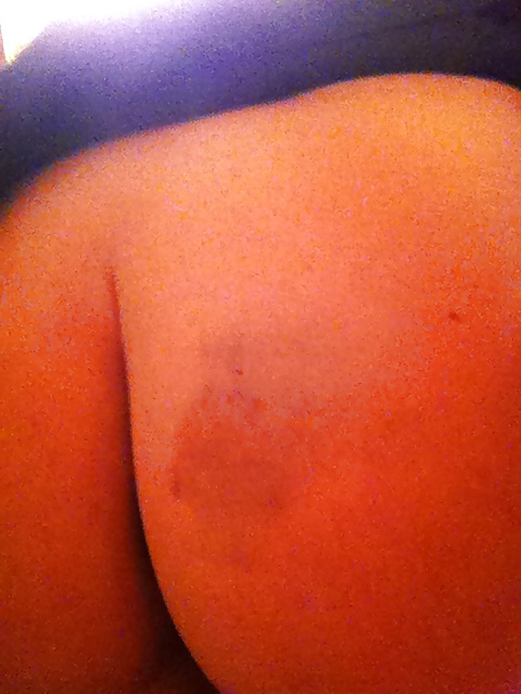 Lovely bruises + more
 #34904910
