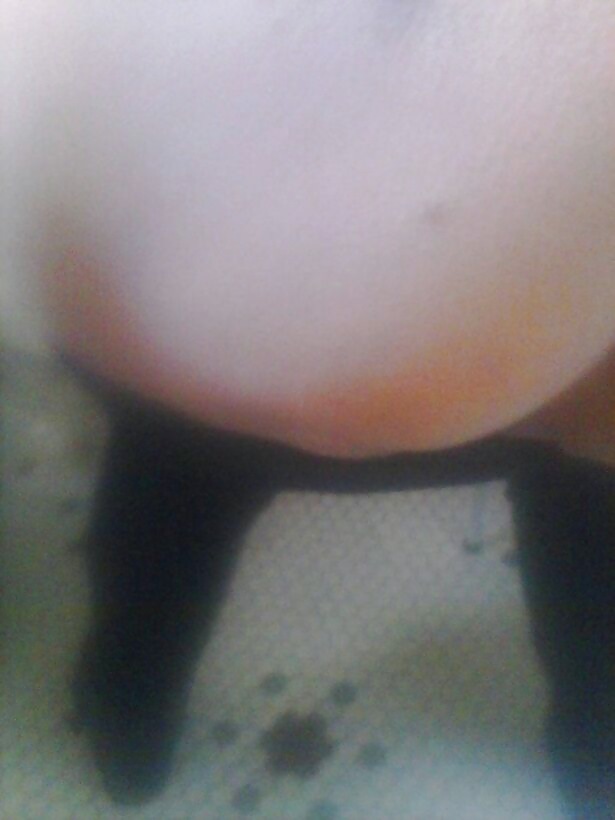 Susan hpv
 #23804931