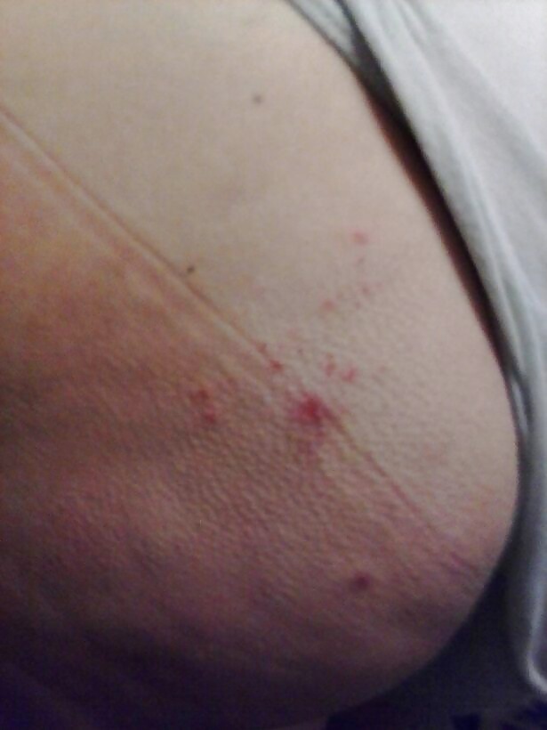 Susan hpv
 #23804944