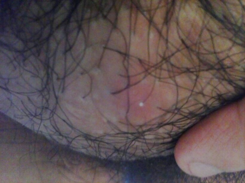 Susan hpv
 #23804977
