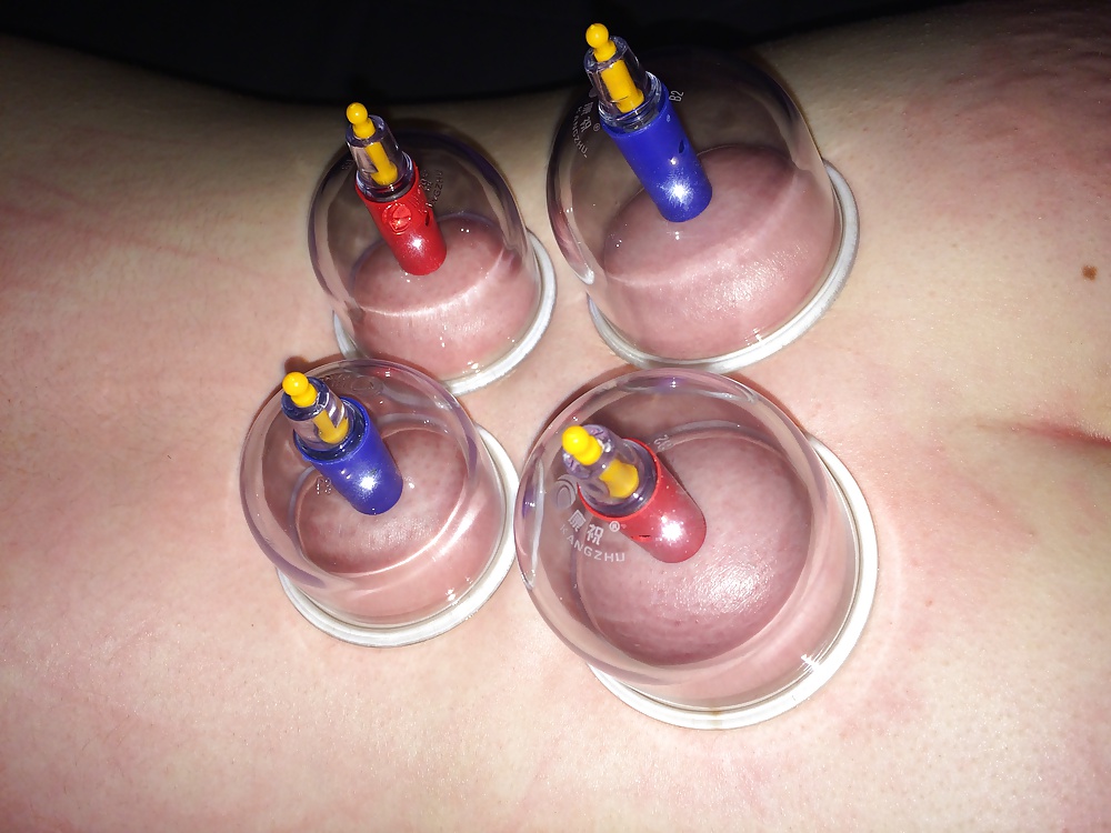 Japanese suction cups massage therapy  #31777187